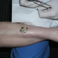 
	Crusted lesion on lower leg