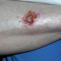 
	Same patient as previous image

	Lesion…