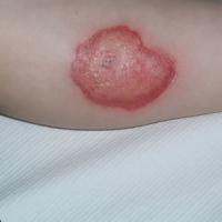 
	Artefactual ulcer

	The patient had done this…