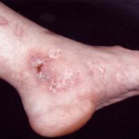
	Livedoid vasculopathy