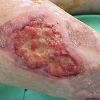 
	Marjolin's ulcer 

	A chronic venous ulcer…