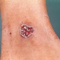 
	Ulcer associated with rheumatoid arthritis 
