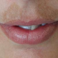 
	Melasma: pre-treatment with Pigmanorm &reg;…