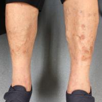 
	Post-treatment

	Good response. Evidence of…