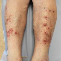 
	Nodular prurigo: pre-treatment

	Dermovate…