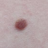 
	With moles and other skin lesions, light coming…