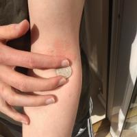 
	Don't cover the affected skin