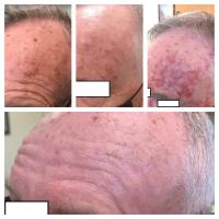 Efudix treatment