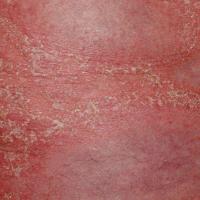 Generalised pustular psoriasis