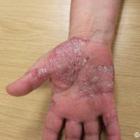 Hyperkeratotic psoriasis