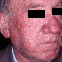 Rhinophyma