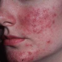 Rosacea - inflammatory