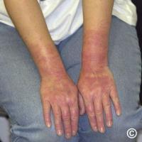 Contact urticaria