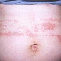 Delayed pressure urticaria