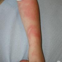 Dermographic urticaria