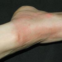 Solar urticaria