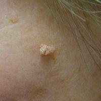 Filiform wart