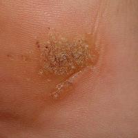 Mosaic warts