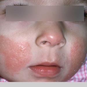 Eczema Unmasked