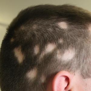 New Clinical Chapter - Alopecia