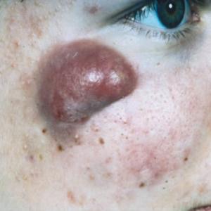 The Future of Acne - Have your Say