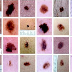 New Dermoscopy Blog - Dr Stephen Hayes
