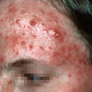 Acne Priority Partnership - Join in Today