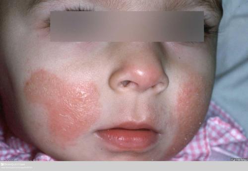 Eczema Unmasked