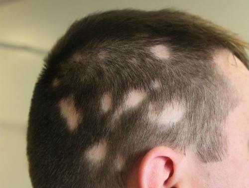 New Clinical Chapter - Alopecia