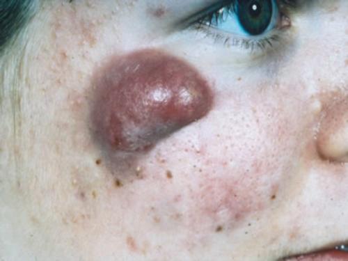 The Future of Acne - Have your Say