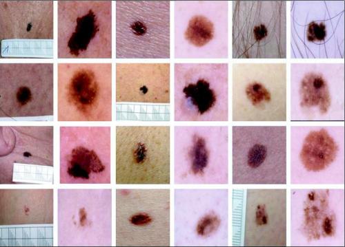 New Dermoscopy Blog - Dr Stephen Hayes