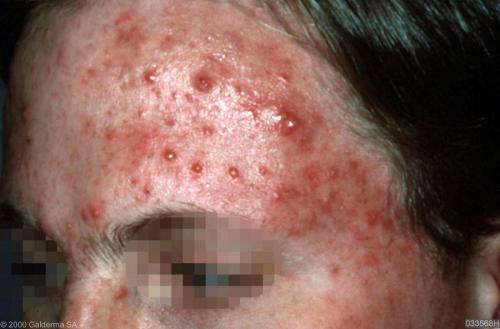 Acne Priority Partnership - Join in Today